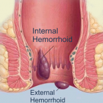 Hemorrhoids picture