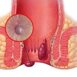 hemorrhoids-picture
