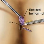 Hemorrhoidectomy