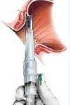 Rubber band ligation surgery