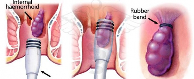 rubber-band-ligation