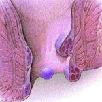 hemorrhoids picture