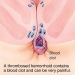 thrombosed-hemorrhoid-picture